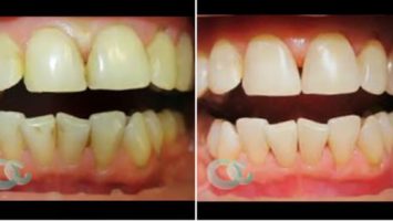 Dentální hygiena před svatbou Brandejs Clinic